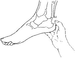 Achilles Tendonitis