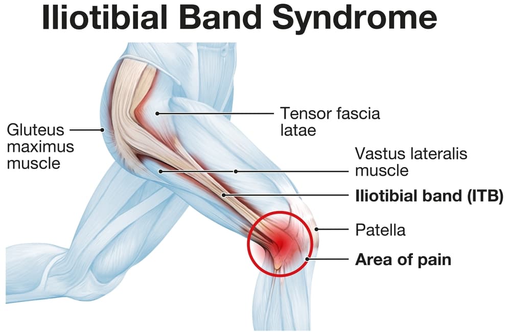 Anatomy diagram of iliotibial band syndrome showing the IT band running from the gluteus maximus and tensor fascia latae at the hip down to the lateral knee, with the area of pain highlighted at the outside of the knee near the patella
