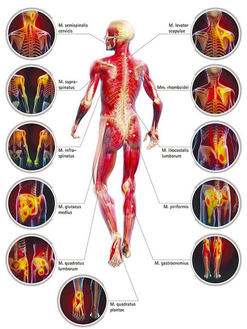 Trigger Points back