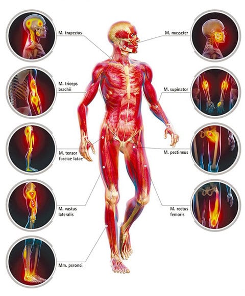 Trigger Points Front